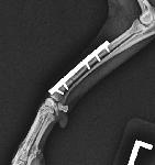 Click here for more information about Fix Broken Bones with Plates and Screws