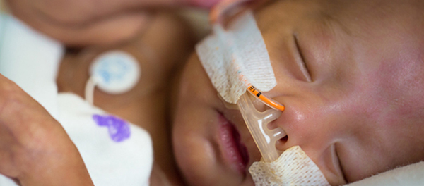 Sleeping baby with feeding and oxygen tubes
